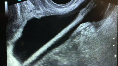 Медики во время операции достали косметический карандаш из мочевого пузыря женщины 11/02/2026 &ndash; Новости