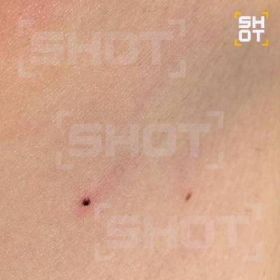 Shot: Жителей России атакуют микроклещи